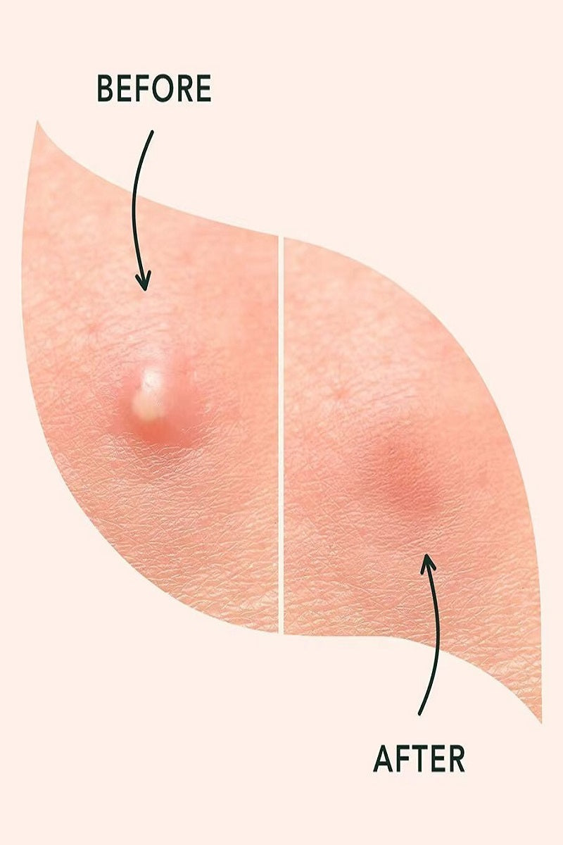 Acne Patch Original Pimple Patch - 36 Count PinkPro Beauty Supply