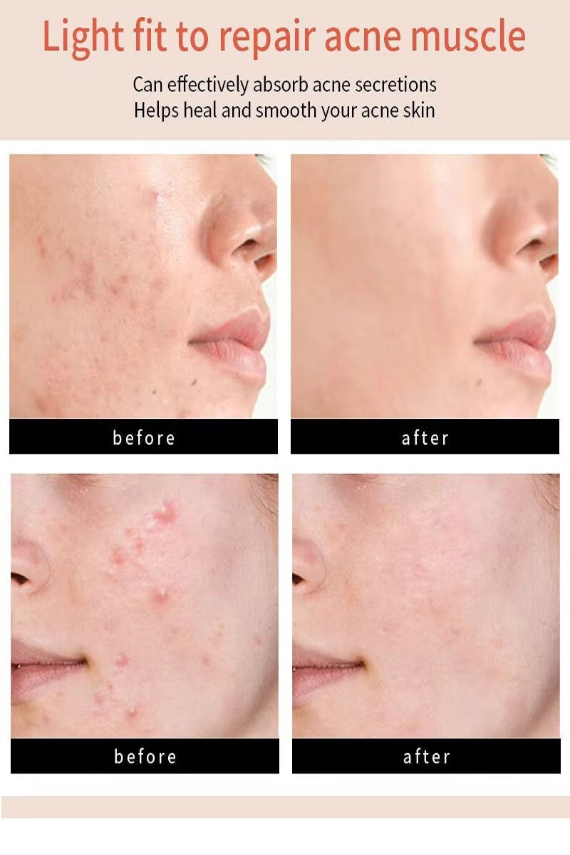 Acne Patch Original Pimple Patch - 36 Count PinkPro Beauty Supply